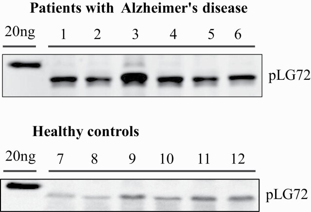 Diagnosing Alzheimer's Disease Specifically and Sensitively With pLG72 and Cystine/Glutamate Antiporter SLC7A11 AS Blood Biomarkers