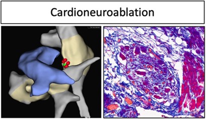 Ischemia-induced ventricular proarrhythmia and cardiovascular autonomic dysreflexia after cardioneuroablation