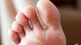 腳發癢、脫皮、臭？你可能「黴」上了！