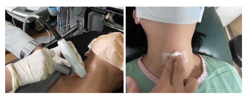 【自費】-甲狀腺結節細針穿刺之甲狀腺癌基因篩檢