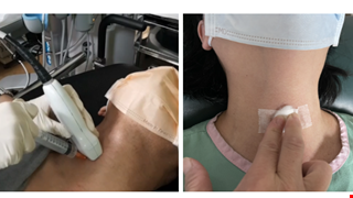 【自費】-甲狀腺結節細針穿刺之甲狀腺癌基因篩檢