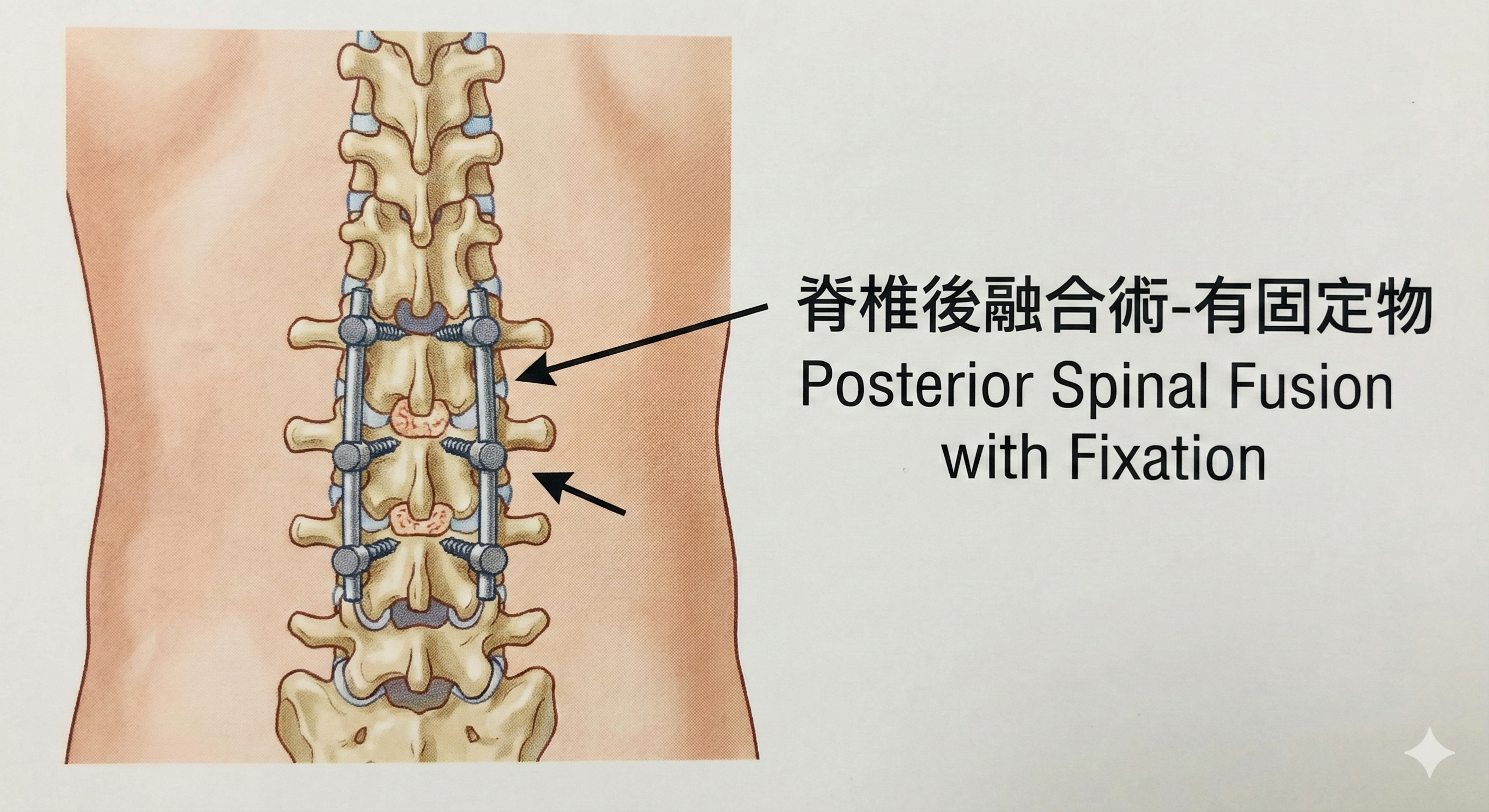 脊椎後融合術-有固定物