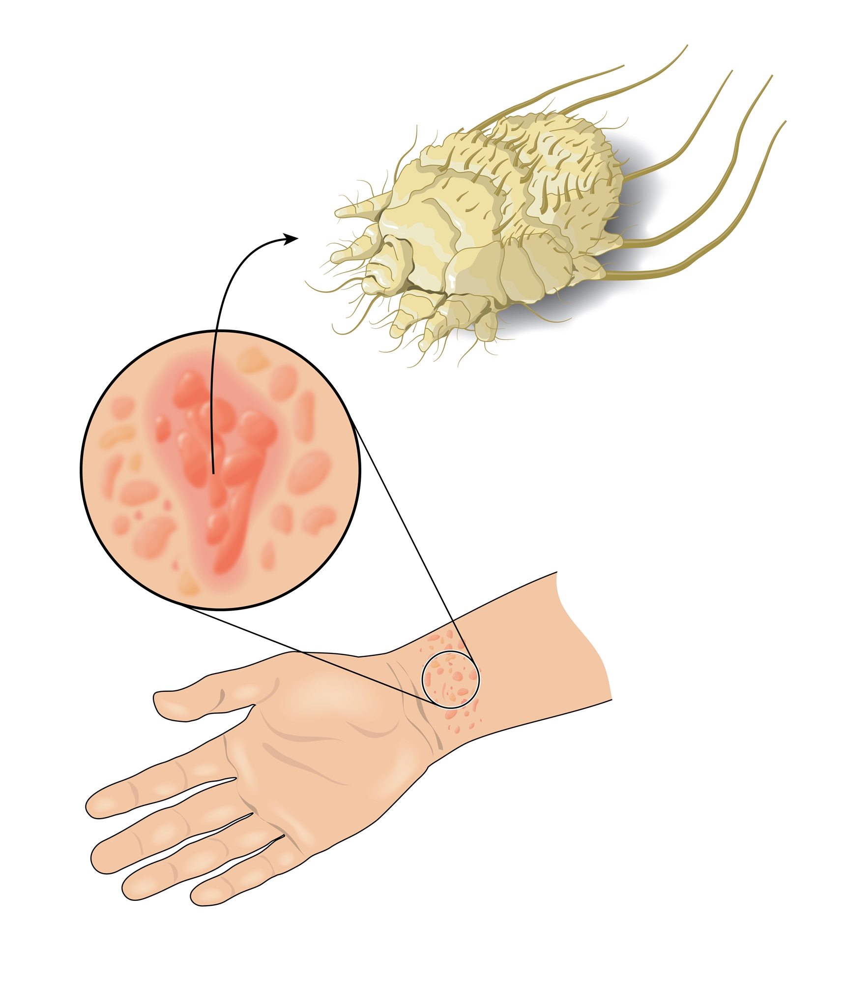 What Is Scabies Symptoms Causes Diagnosis Treatment Off